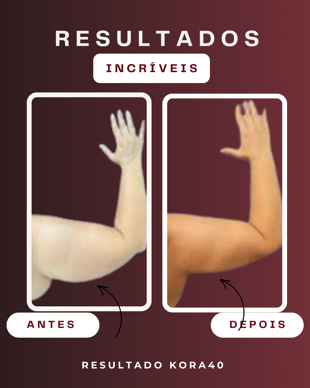Resultado KORA - Pernas Leves